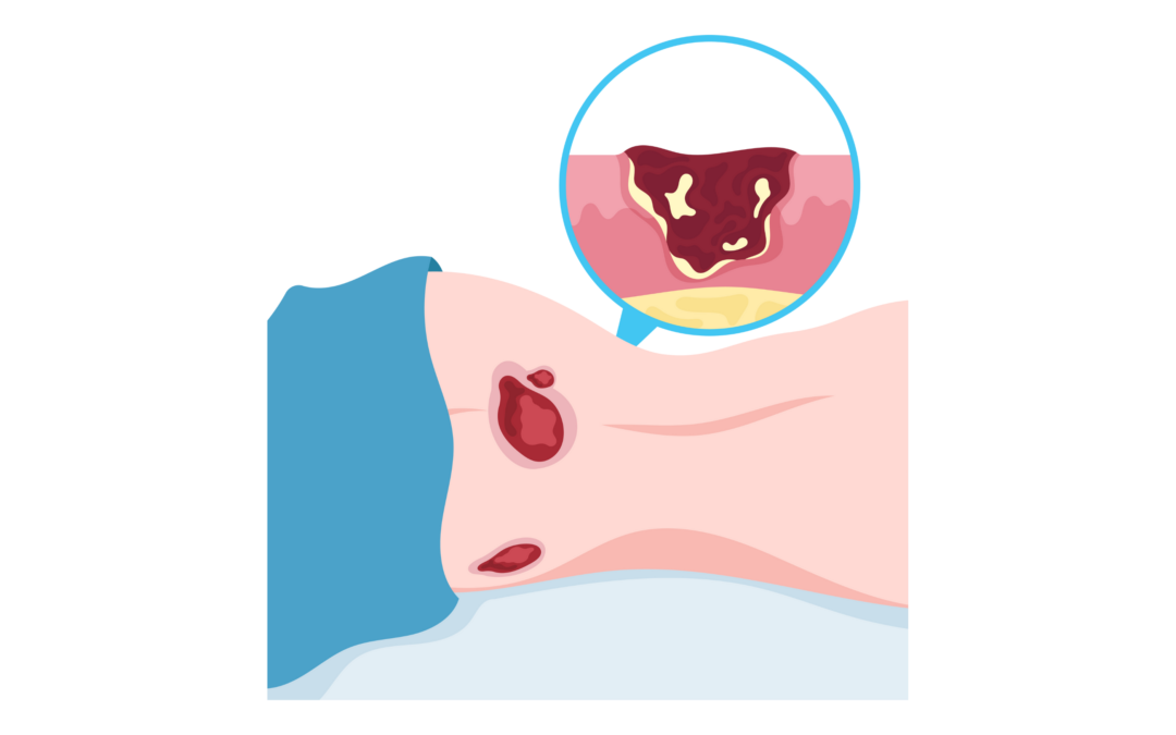 UZ Gent halveert doorligwonden door systematische preventie