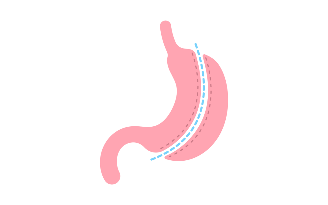 Bariatrische chirurgie en het risico op alcoholverslaving