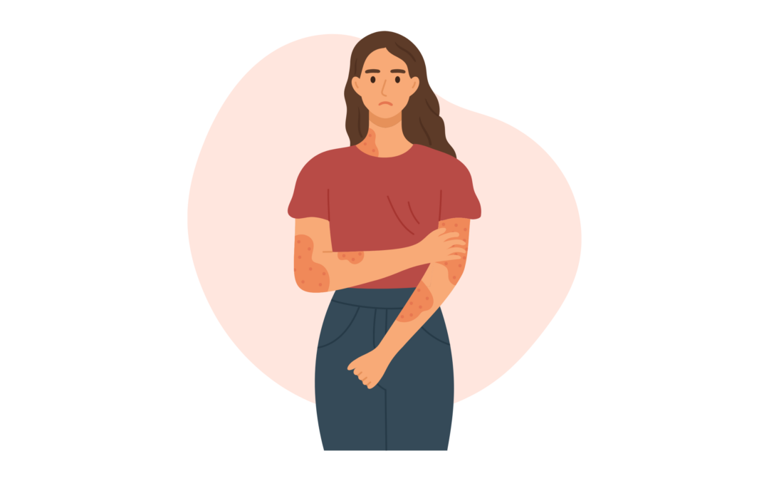 Psoriasis: minder biotherapie, dezelfde werkzaamheid