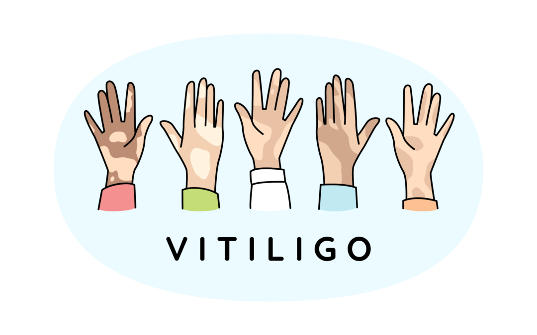 Bijna één op de vier patiënten met vitiligo lijdt aan een ernstige depressie