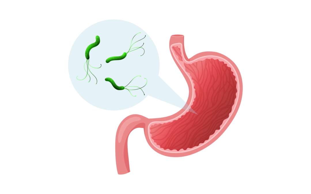 Helicobacter pylori: een bewezen rol in de maag, een nieuw spoor bij colorectale kanker